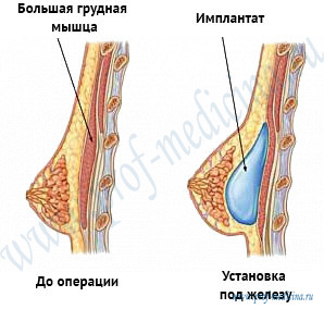 Имплант под мышцу сколько болит