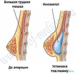 Имплант под мышцу сколько болит