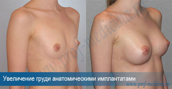 Фото до и после увеличивающей пластики груди