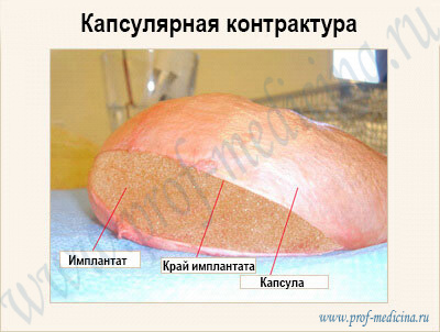 Капсулярная контрактура