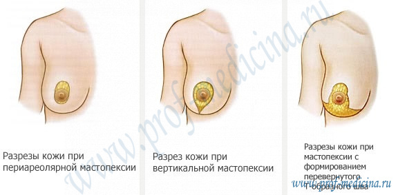 Разрезы при подтяжке груди