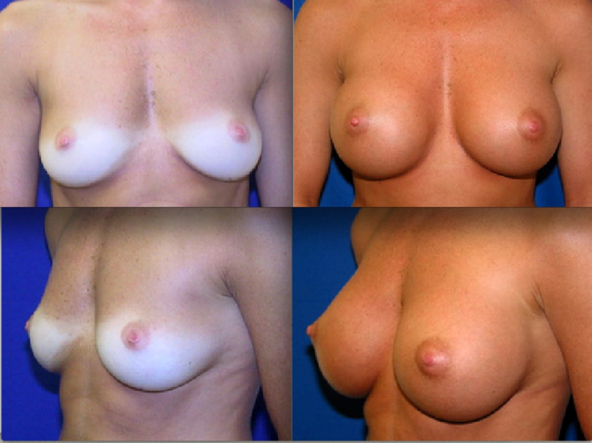 Breast Augmentation