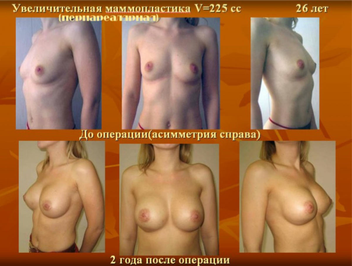 Сиськи до и после родов могу siski-do-i-posle-rodov