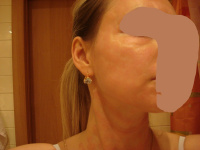 Аппарат для лазерного омоложения кожи лица palovia laser palomar отзывы