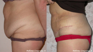 Фото: Абдоминопластика (пластика живота), Соколов Александр Анатольевич