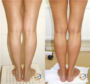 Круропластика ног. Круропластика голени асимметрия голени. Круропластика (пластика голеней) что это. Круропластика на худые ноги.