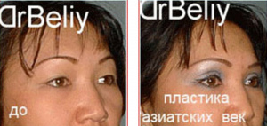Белый Игорь Анатольевич Блефаропластика (Пластика век)