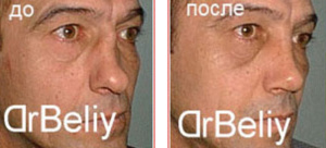 Белый Игорь Анатольевич Ринопластика (Пластика носа)