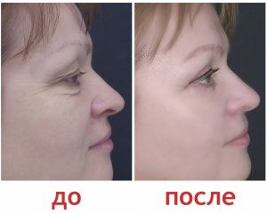 Анатолий Барбакару Фото До И После Пластики