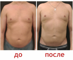 Зленко Владимир Александрович Липосакция