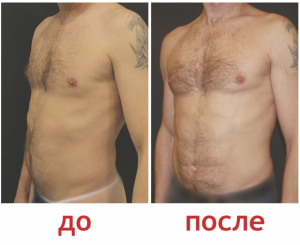 Зленко Владимир Александрович Липосакция