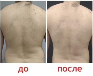 Зленко Владимир Александрович Липосакция