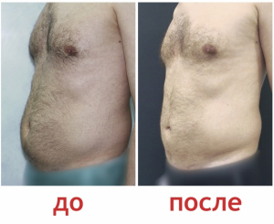 Зленко Владимир Александрович Липосакция