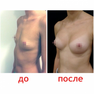 Зленко Владимир Александрович Увеличение груди