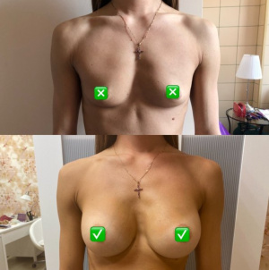 Рыжова Светлана Дмитриевна Увеличение груди