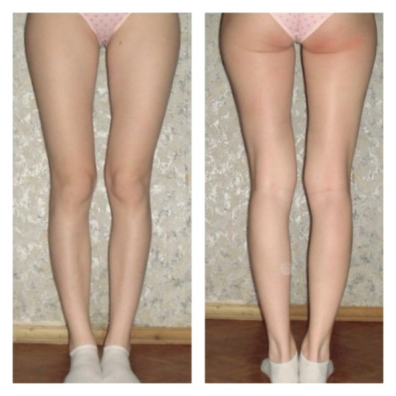 Круропластика ног. Капсульная контрактура круропластика. Круропластика фото до и после. Пластика ног (круропластика).