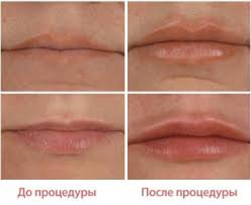 Фото Тонких Губ После Увеличения 1 Мл