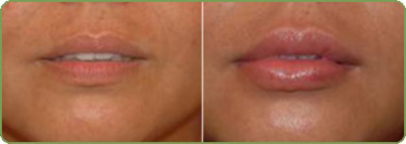 Удаление малых губ до и после фото. Коррекция формы губ филлером. Увеличение губ до и после.