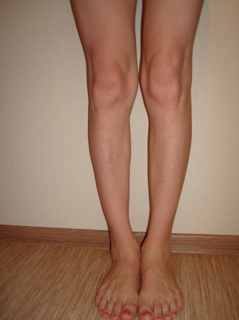 Круропластика ног