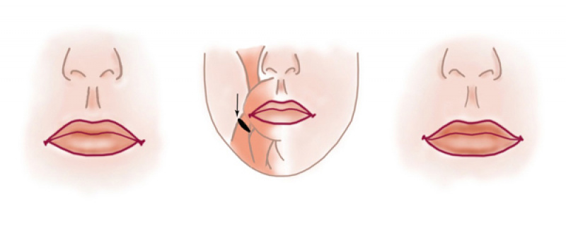 Опущение угла рта. Пластика губ резекция dao. Корнер лифт уголков губ. Корнер лифт губ+булхорн. Резекция dao (мышцы, опускающей угол рта).