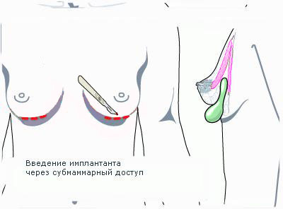 Увеличение груди. Виды доступа.