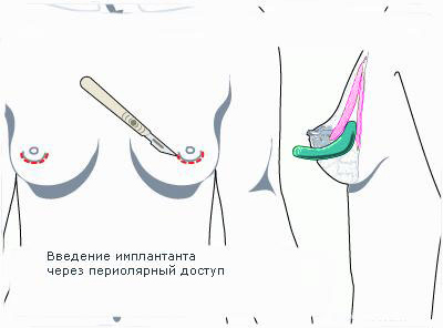 Увеличение груди. Виды доступа.