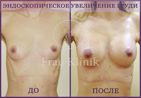 Эндоскопическое увеличение груди - без следа от операции