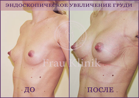 Эндоскопическое увеличение груди - без следа от операции
